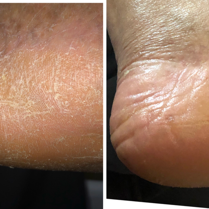 Organic Hands and Feet Salve (Dry Skin)